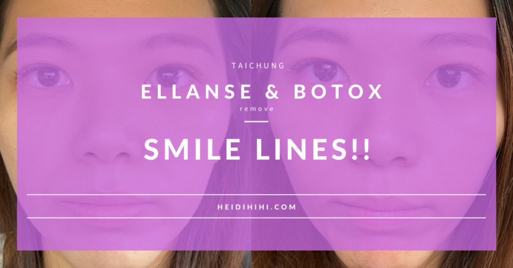 Ellanse & Botox改善法令紋