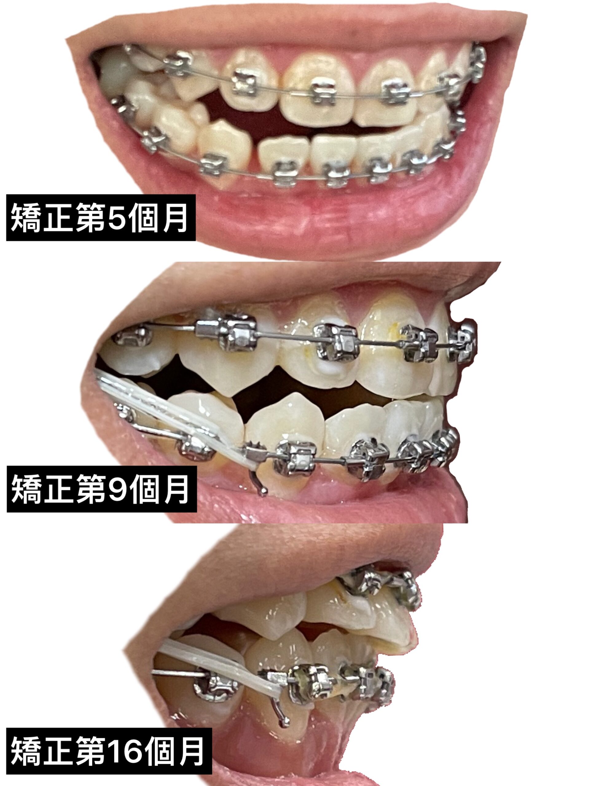 矯正牙齒側面紀錄